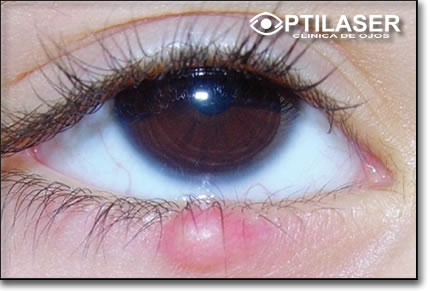 Clinica de ojos Optilaser - Chalazion